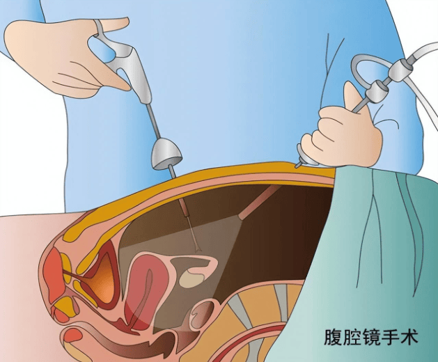 尤其是在治疗卵巢巧克力囊