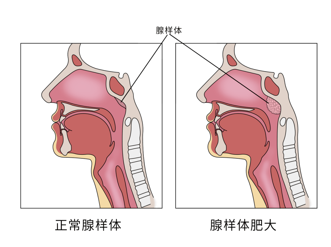 腺样体肥大的位置图片图片