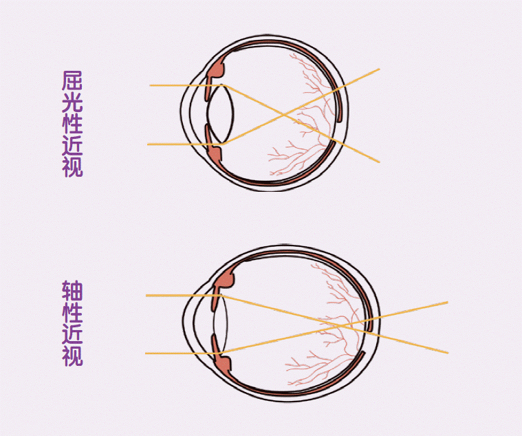 清晰眼科 | 一文带你从根源了解近视的原理!