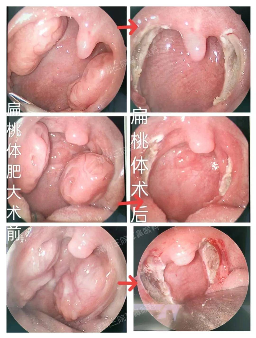 儿童扁桃体切除术图片