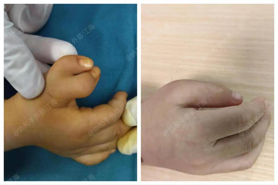 多指│案例7《手术白做了?术后"和没做一样"!》