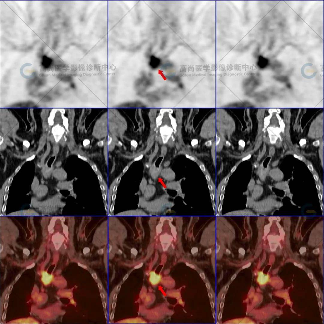 高尚病例 pet/ct协助诊断气管鳞癌1例