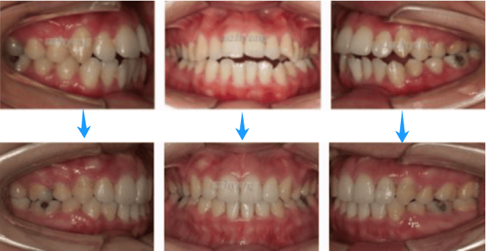 牙齿开合的病因,危害及开合矫正_前牙_后牙_口腔