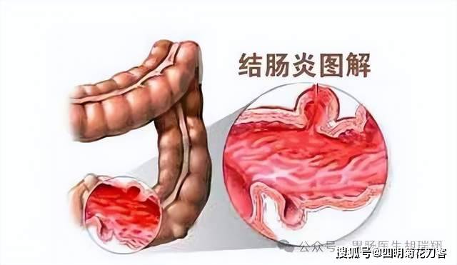 肠炎症状疼痛位置图图片