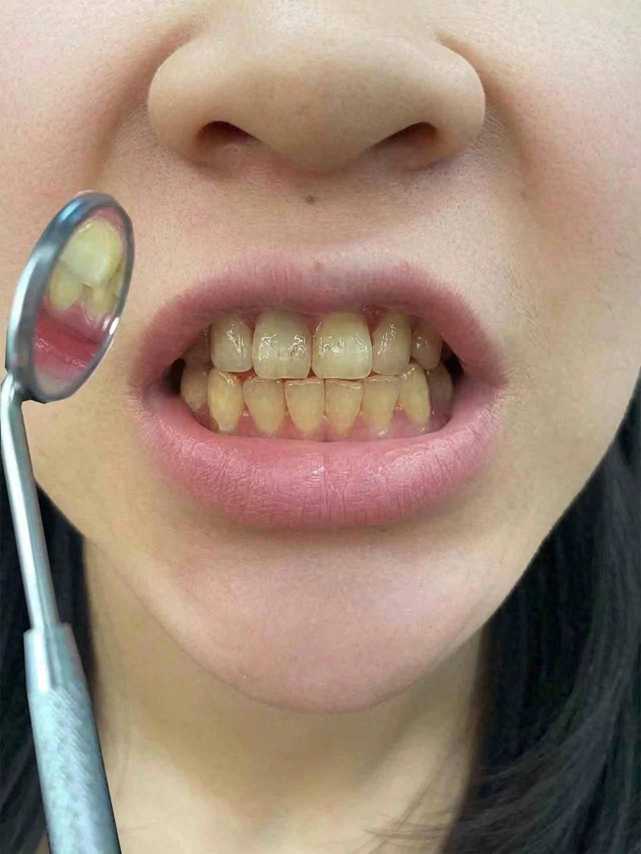 咖啡渍黄牙就这么白了?网友推荐的方法可真牛!_牙齿_效果_牙粉