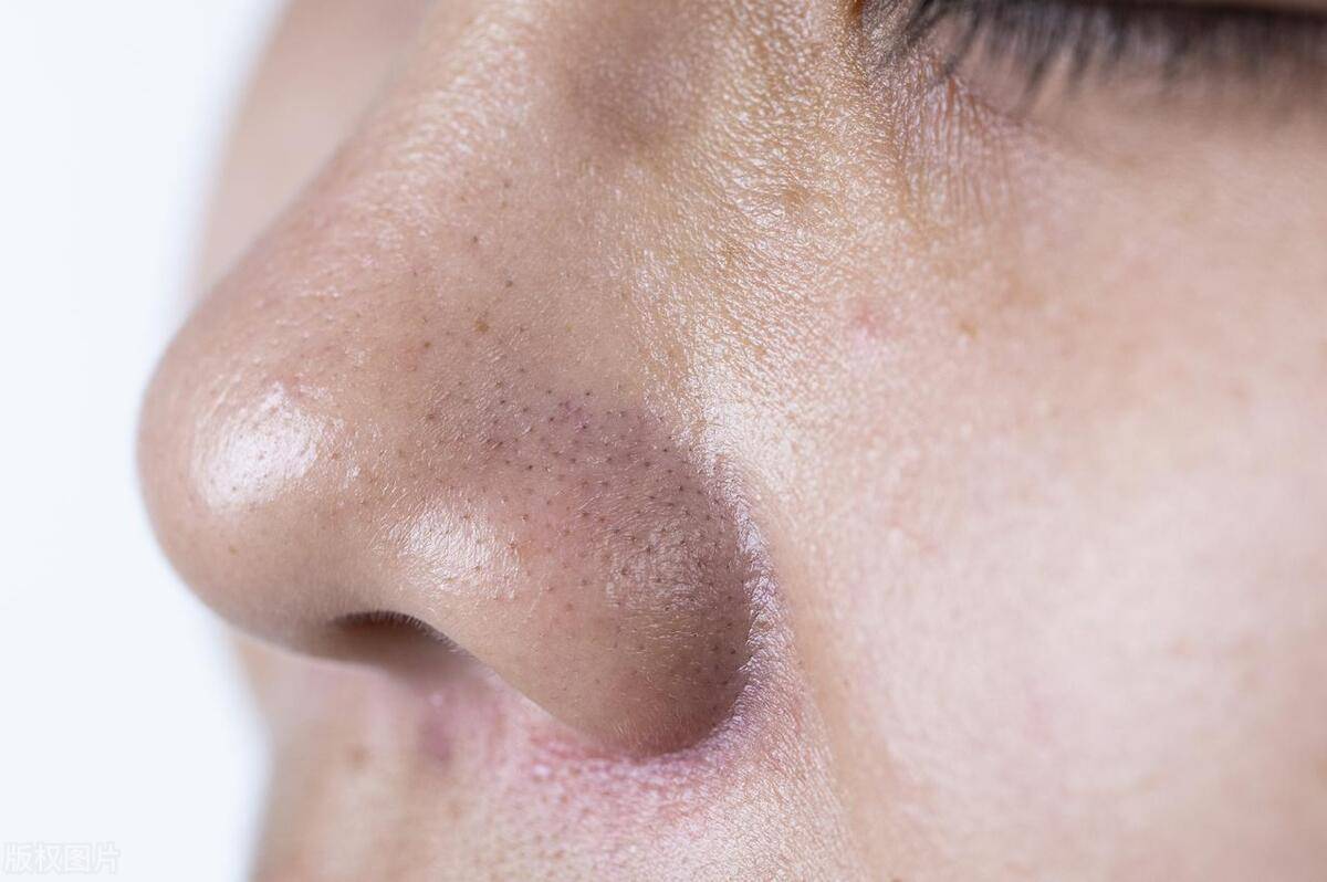 毛孔粗大真的离不开日常护理,能救一个是一个!