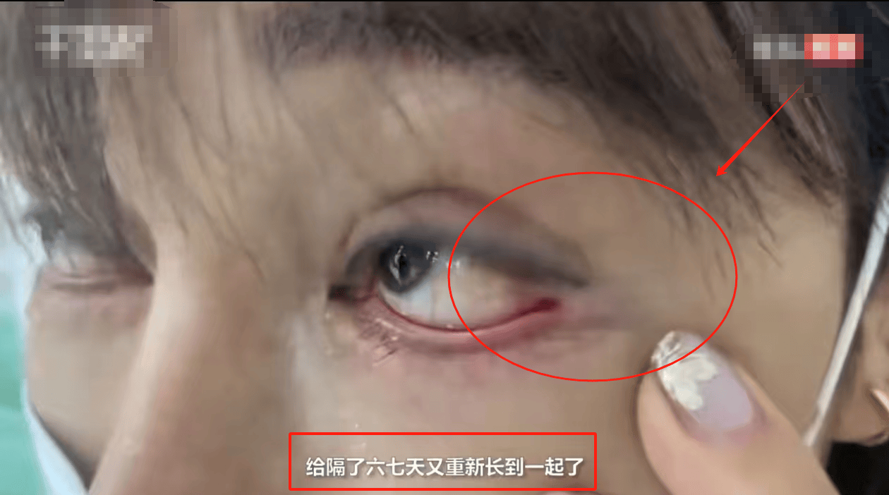 女子称花3万整容 眼球眼角被缝一起,整形医院只赔1万