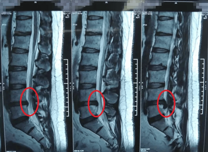 腰间盘突出ct片教程图片