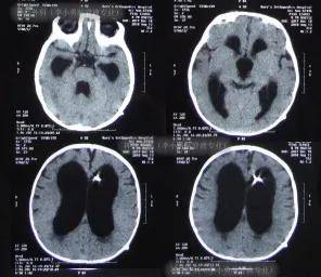 脑积水的头型图 头颅图片