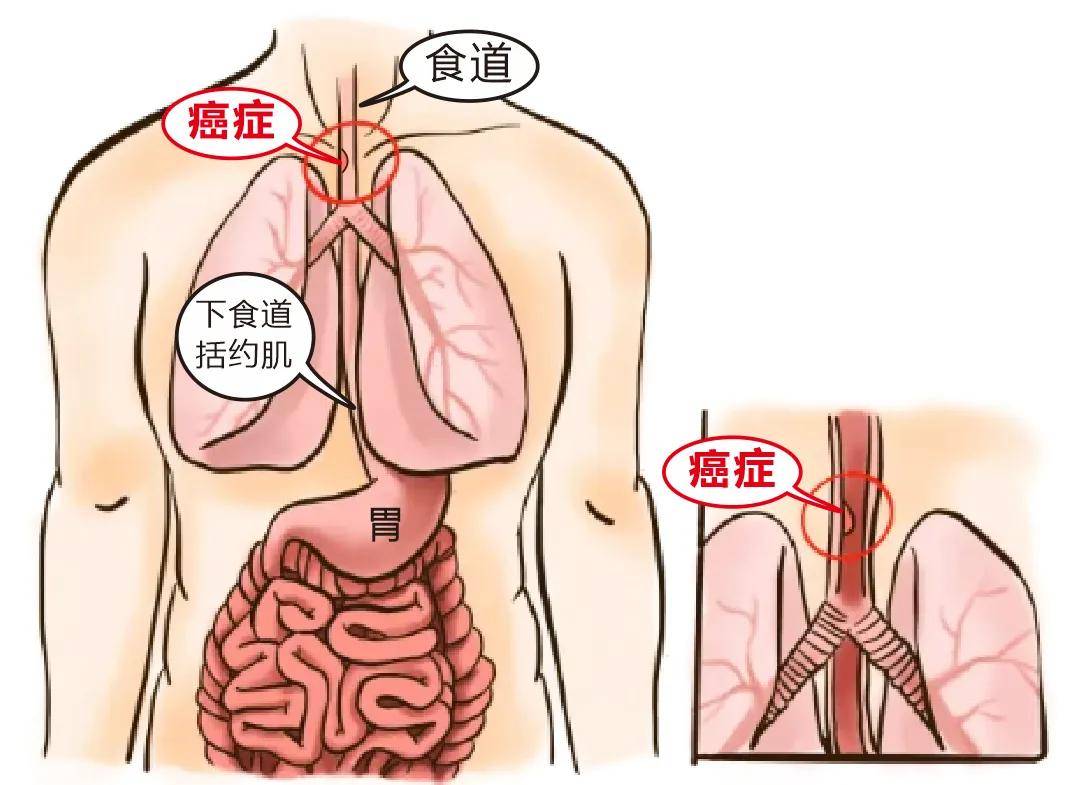 食管癌患者关爱日