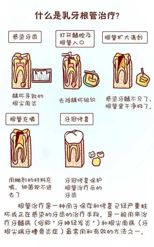 乳牙根管治疗根管治疗的必要性:根管治疗是针对牙髓炎,根尖周炎等病变