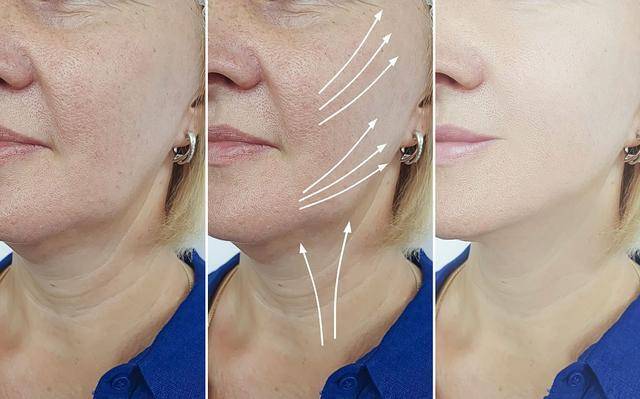 线雕的副作用和危害,面部线雕的副作用和危害详解!