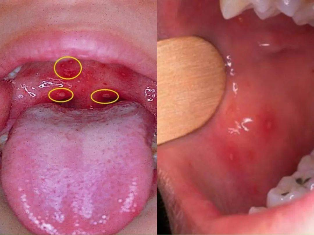 口腔疱疹疼吗图片