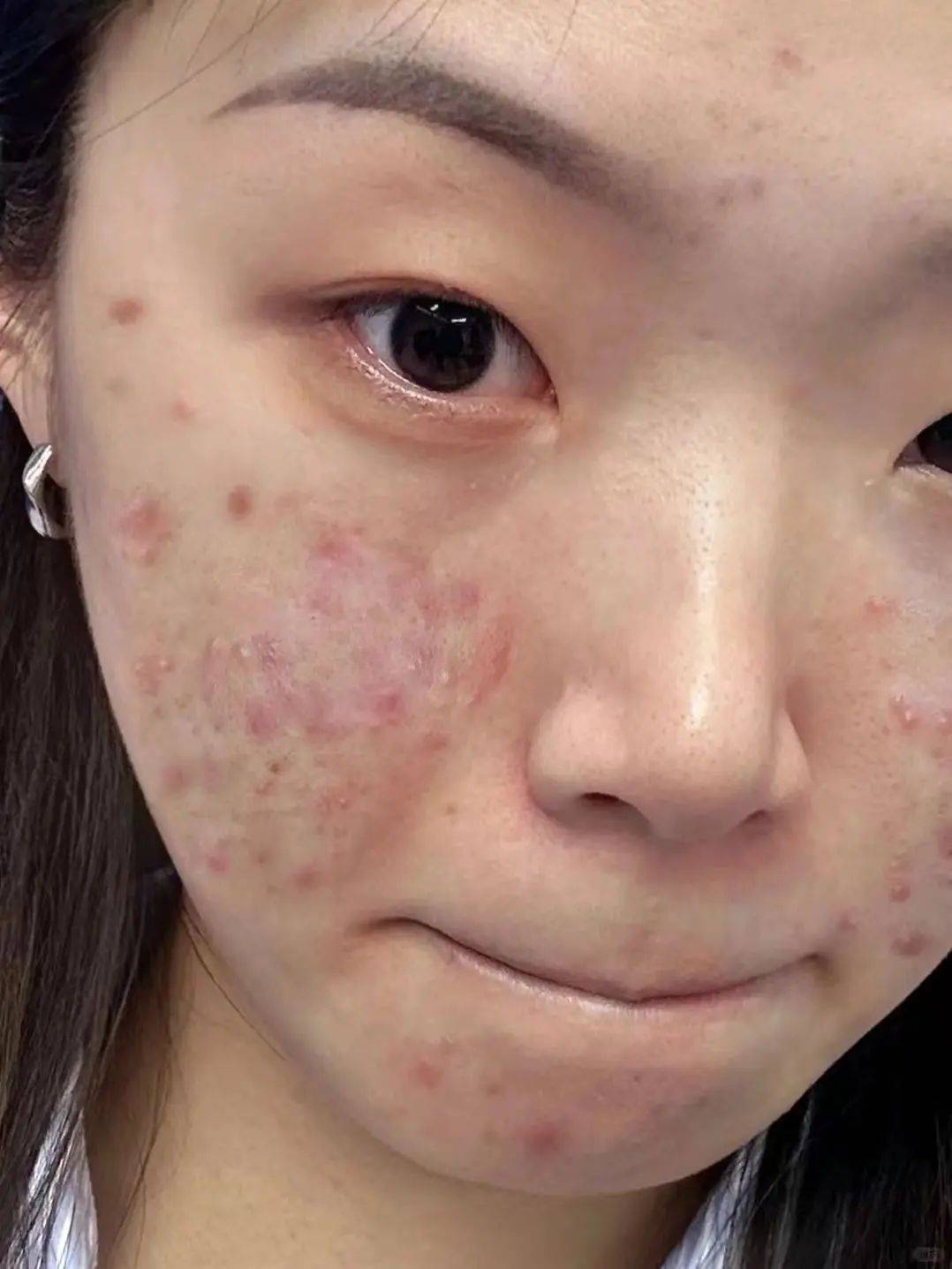 满脸痘痘到底怎么去除?过来人分享亲测妙招,1个月恢复妈生皮!