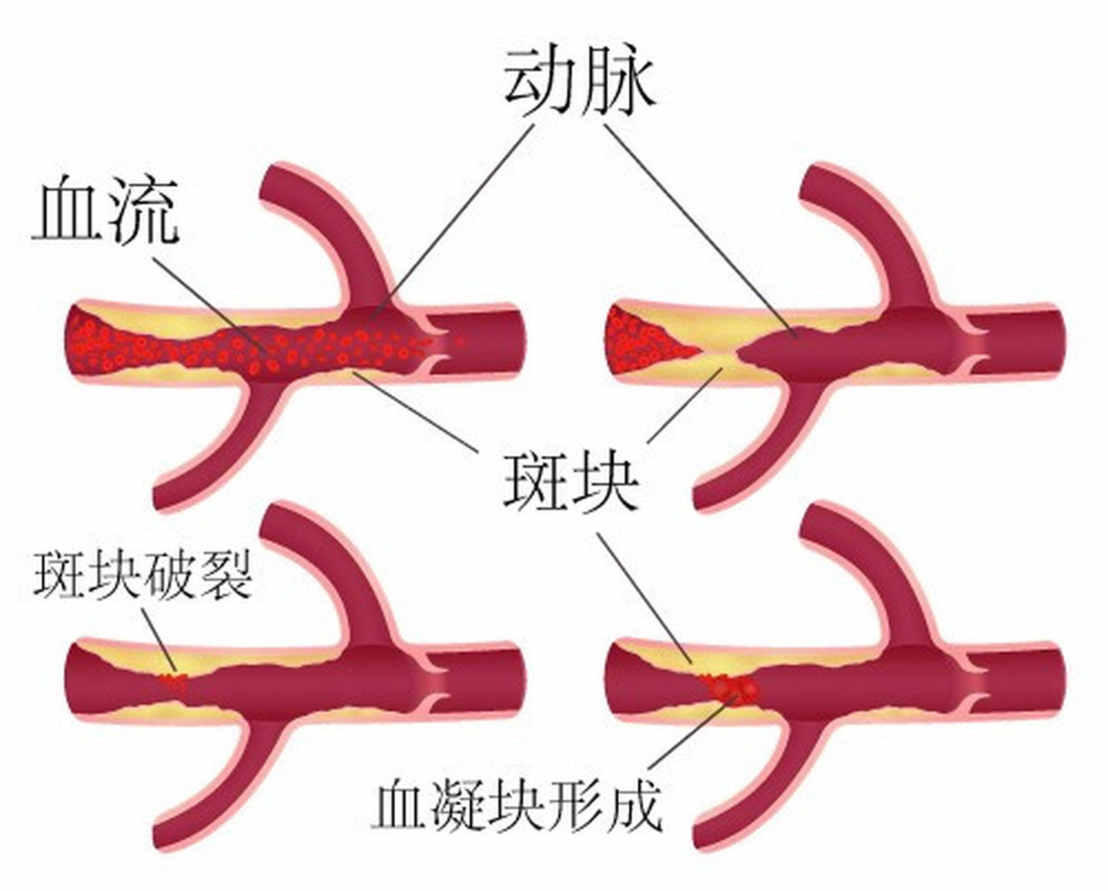 左侧颈动脉斑块形成图片