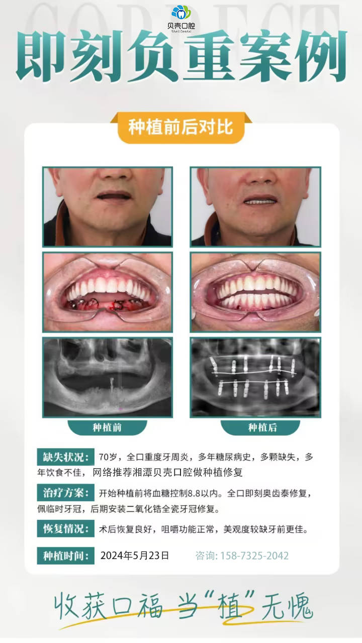 郭爷爷1天"长"新牙,即刻种植牙,恢复"好牙口"