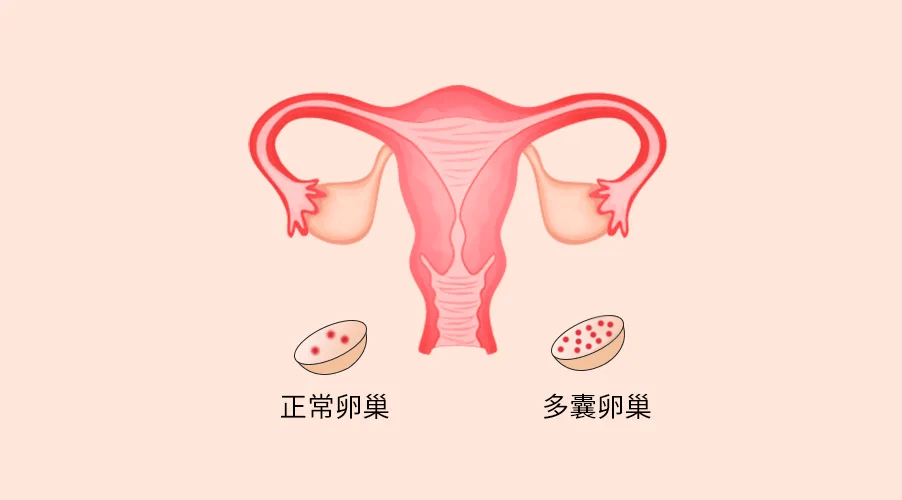 出现这5个情况,可能是多囊卵巢综合征