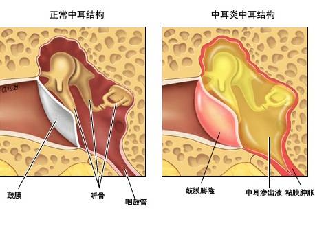 余干万聪听力分享:中耳炎用户选择助听器要注意什么?