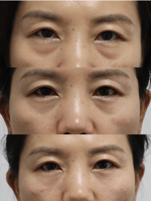 北京西美【眼整形】刘野医生/院长:既有眼袋又有泪沟,该怎么办?