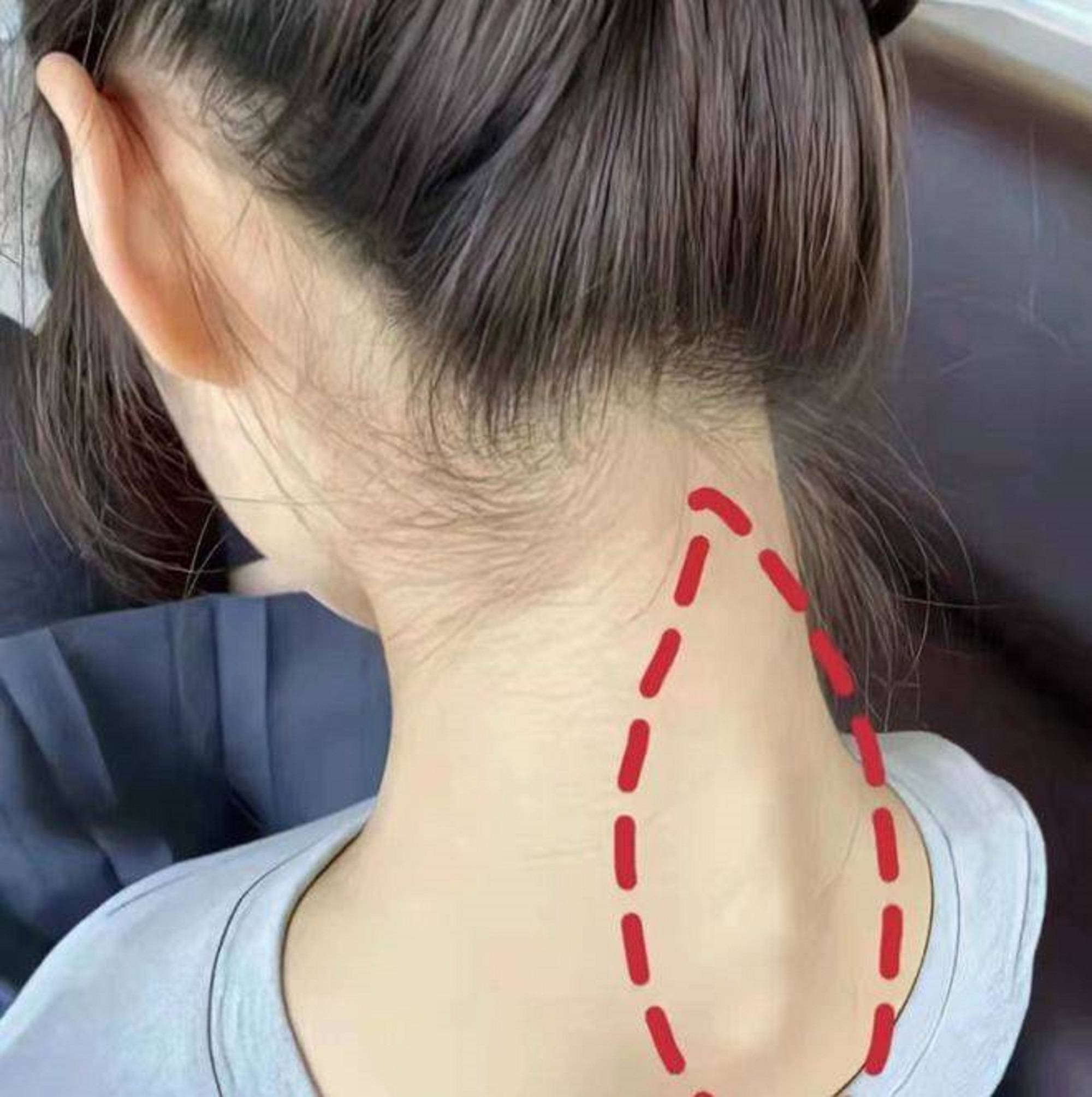 颈椎病不再愁,双11囤这3款自用膏药,在家也能治脖子痛!