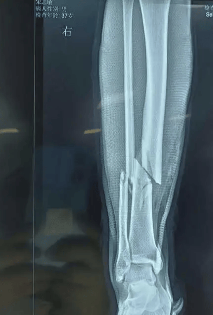 库里伤缺,爵士亨德里克斯右小腿骨折重伤,希尔顿防守差