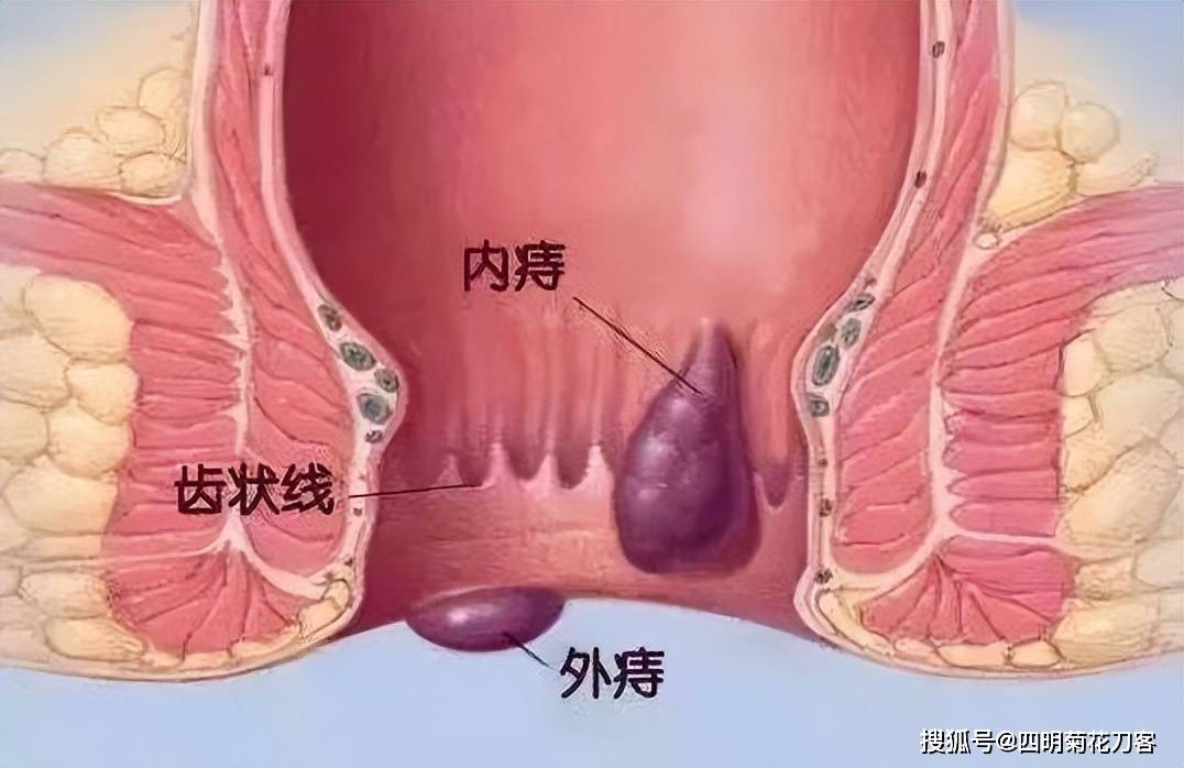 痔疮女性 图解图片