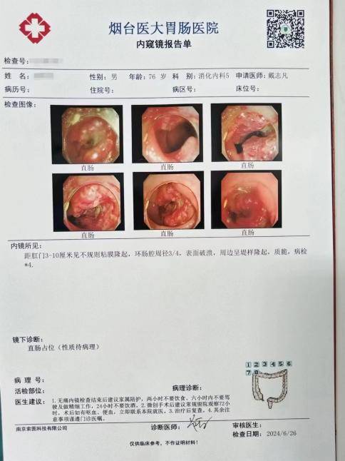 直肠癌一二三四期图片图片