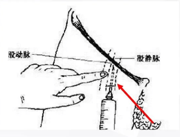 股静脉定位方法示意图图片