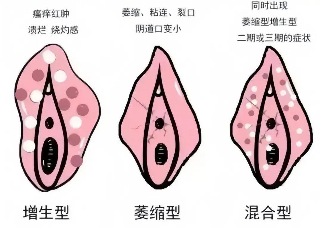 外阴白斑病症状图片