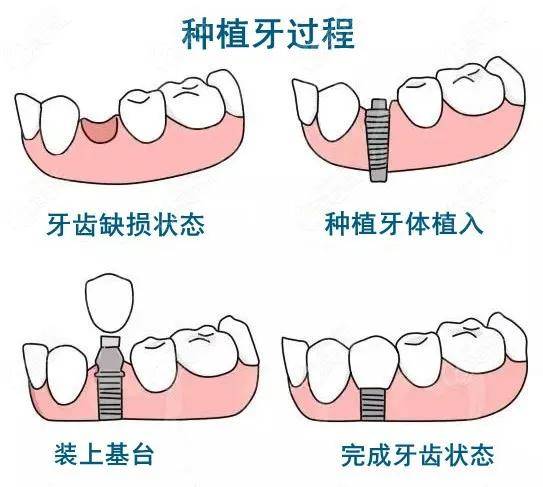 摘牙套的过程图解图片