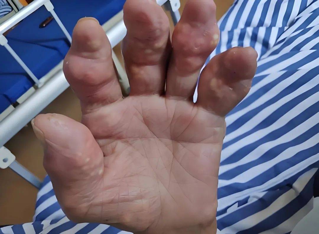 尿酸结晶沉积的部位,危害远不止疼痛?痛风专家周桂兰为你揭晓!