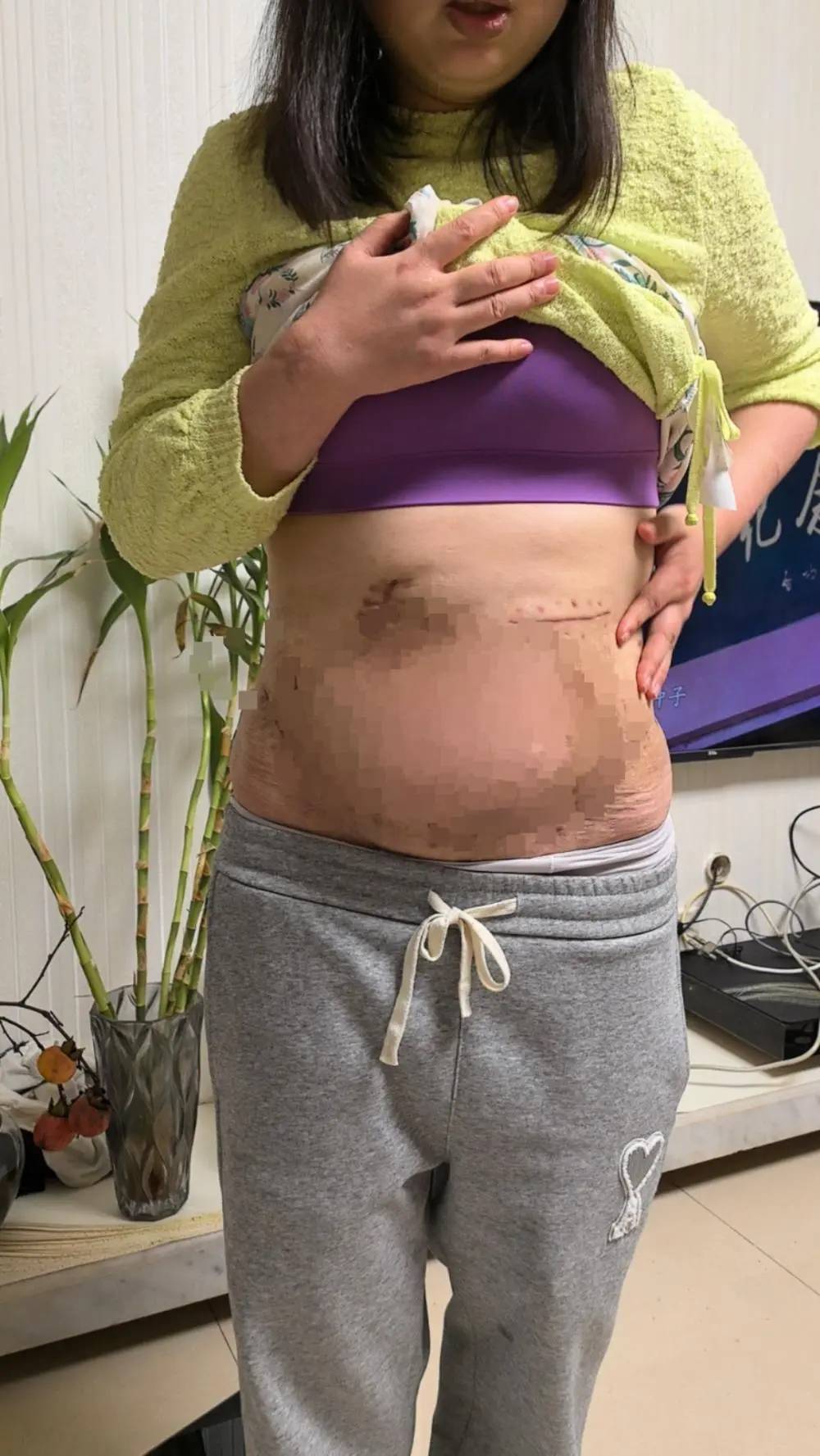 女子在陈清整形医学美容门诊抽脂失败 出现肠穿孔等22病症(图4)