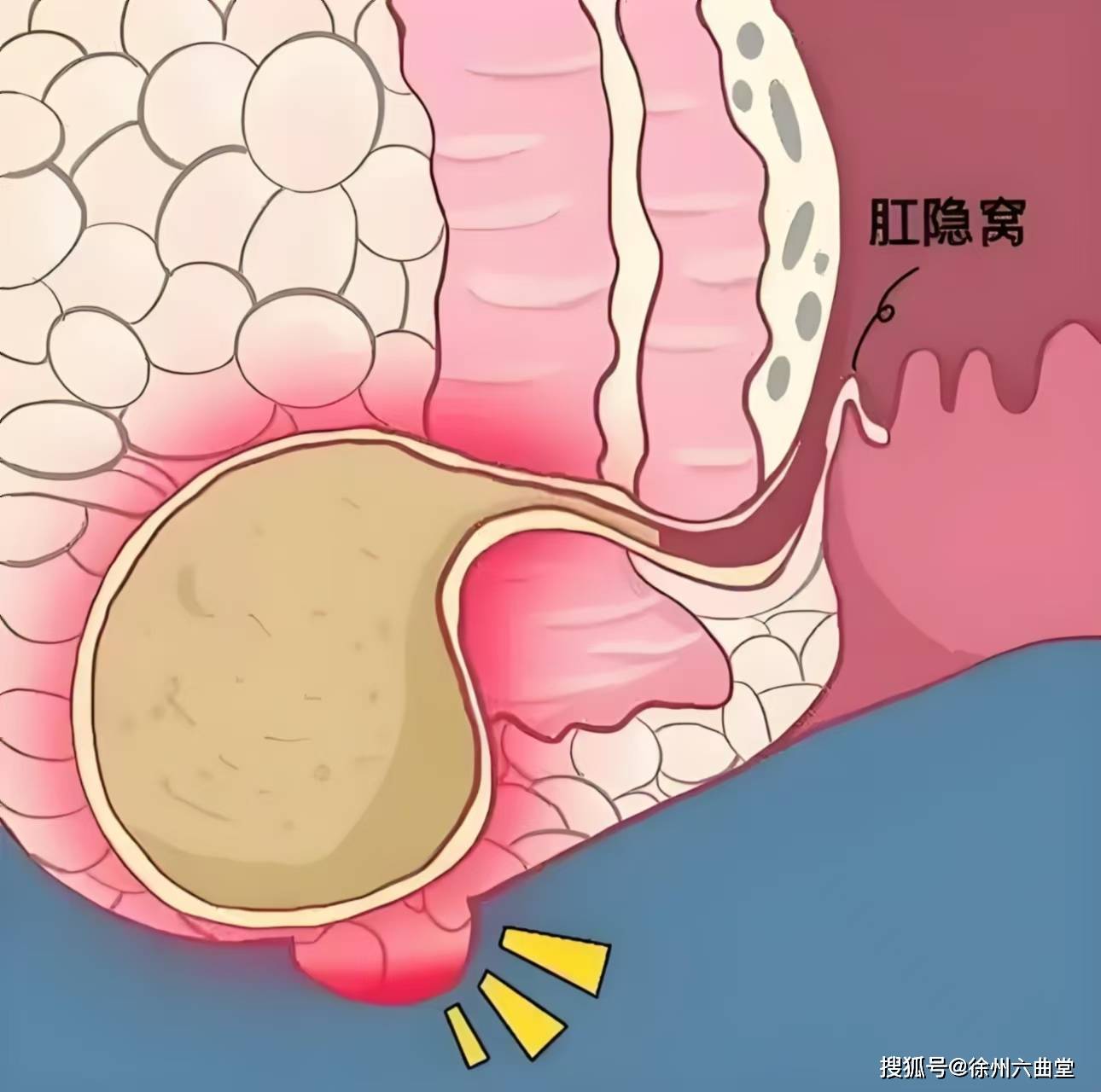 为什么肛周脓肿手术后伤口有分泌物百科在线