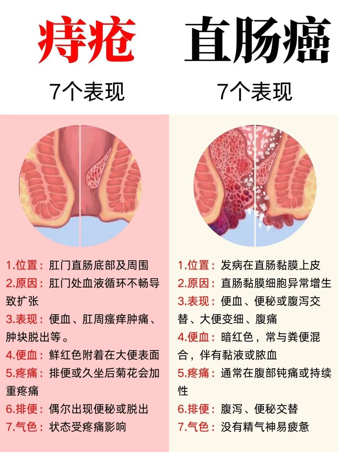 怎样分辨是不是痔疮图片