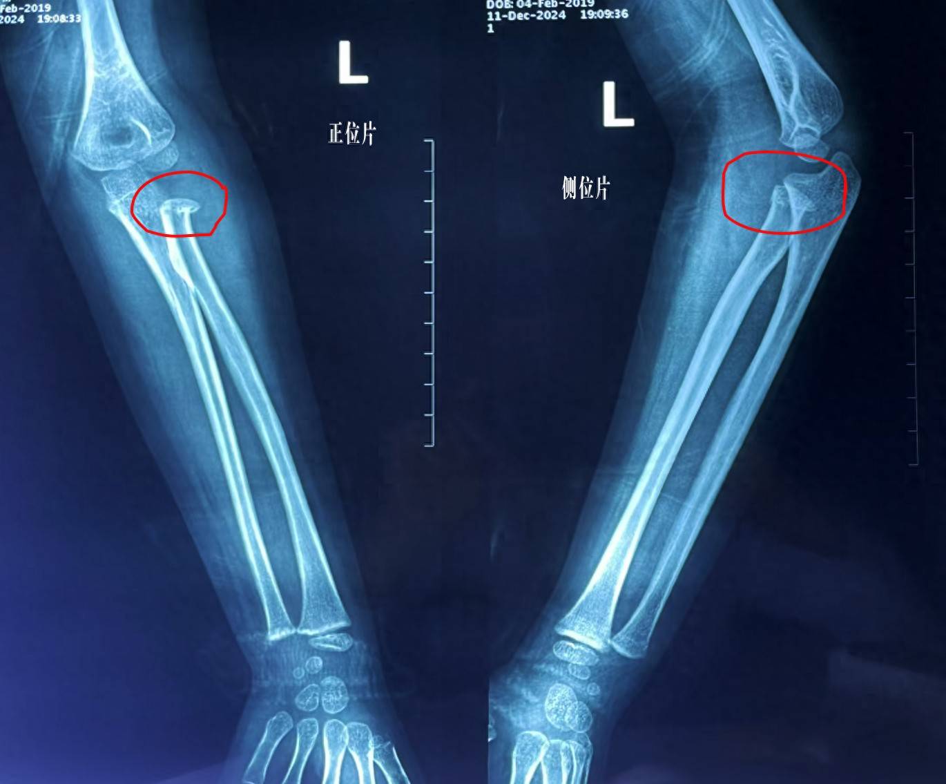 轻松"骗过"x光机,被他的南詹正骨手法惊艳到了!