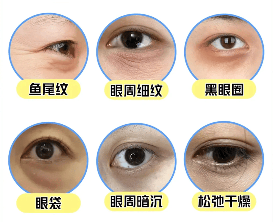 邯郸整形刘芳:解析眼周衰老的成因及改善思路