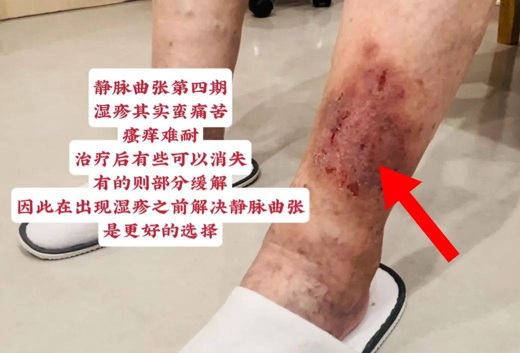 还有静脉曲张患者不知道如何应对湿疹与瘙痒?