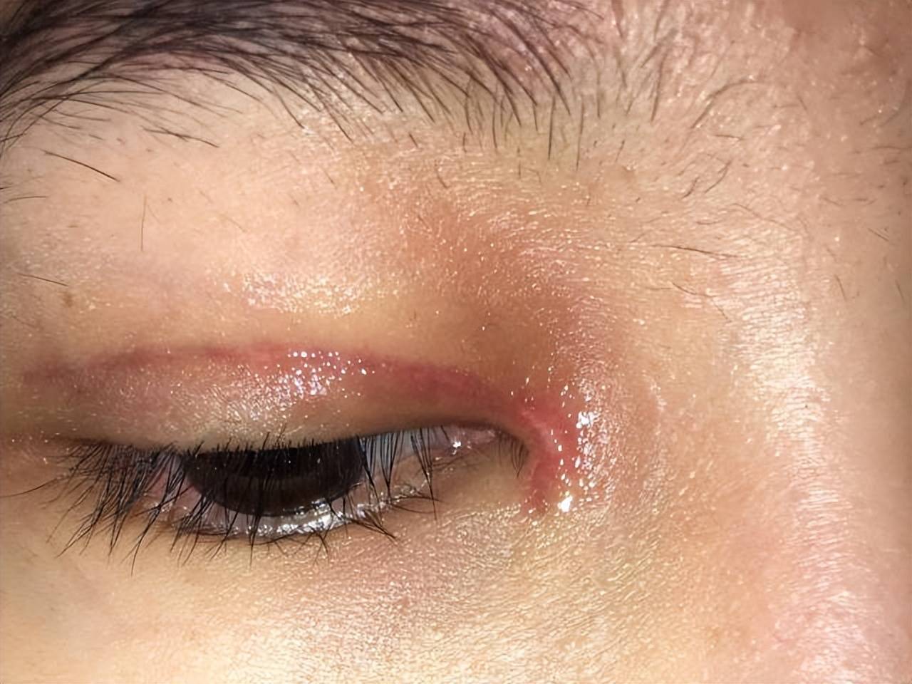 疤痕体质双眼皮手术后祛疤秘籍:两个月告别增生疤痕!