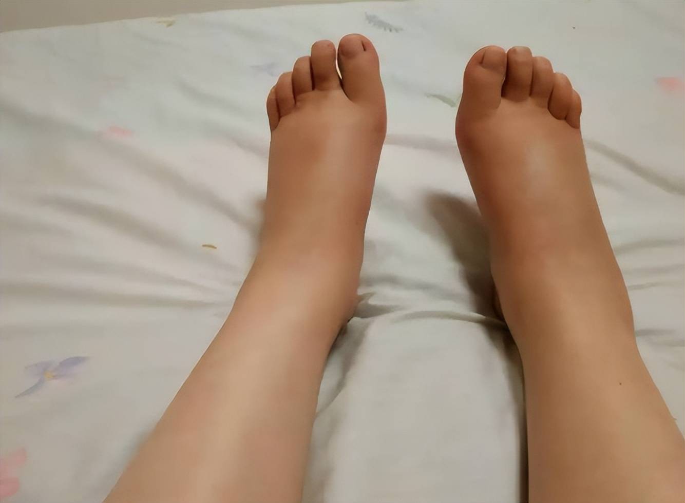 脚部若现5种异常,血栓可能已形成!