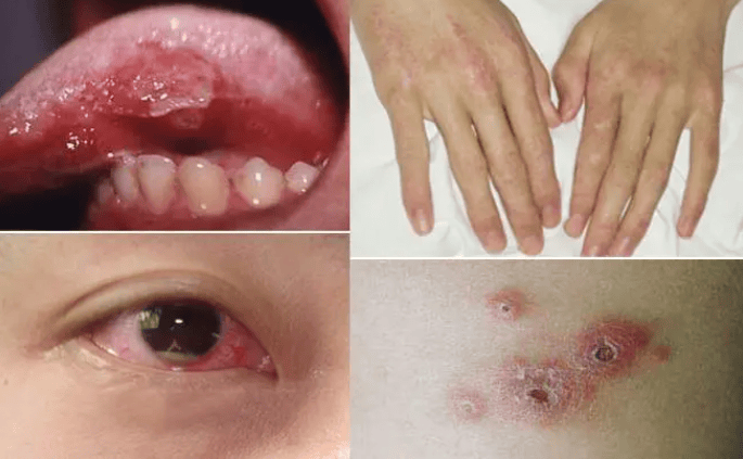 从口腔溃疡到全身病变:白塞氏病敲响的健康警钟