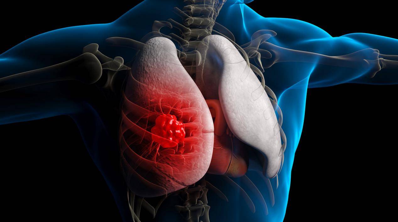 警惕身体发出的求救信号！这6个症状可能是肺癌前兆 