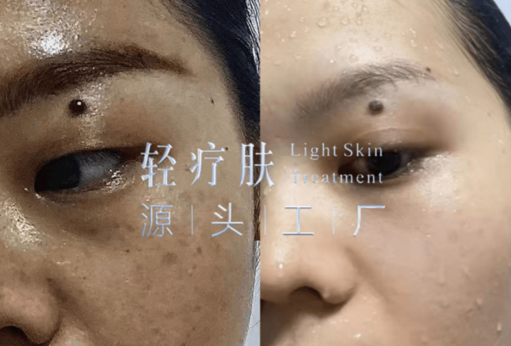 轻疗肤是正规品牌吗 轻疗肤可以祛斑吗