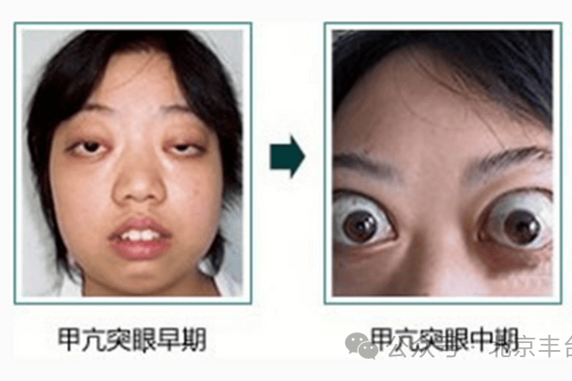 甲亢突眼终于好转了,眼干眼涩好了,6个小技巧,教你解决甲亢突眼问题!