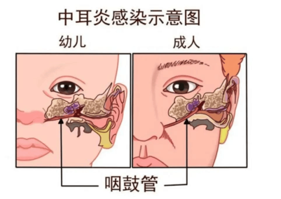 特殊的结构使得鼻腔和咽喉部的细菌,病毒更容易通过咽鼓管进入中耳腔