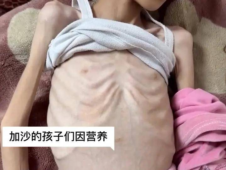 环球计划手册:营养不良管理