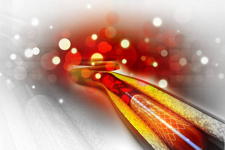 大骗局：心脏支架多年来已经被搬到国外了吗？