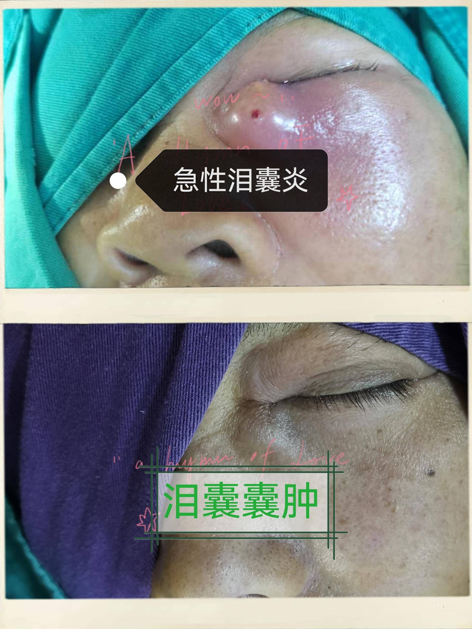 十年前,曾阿姨的左眼开始出现无诱因流泪现象,泪囊区还时常鼓起一个小