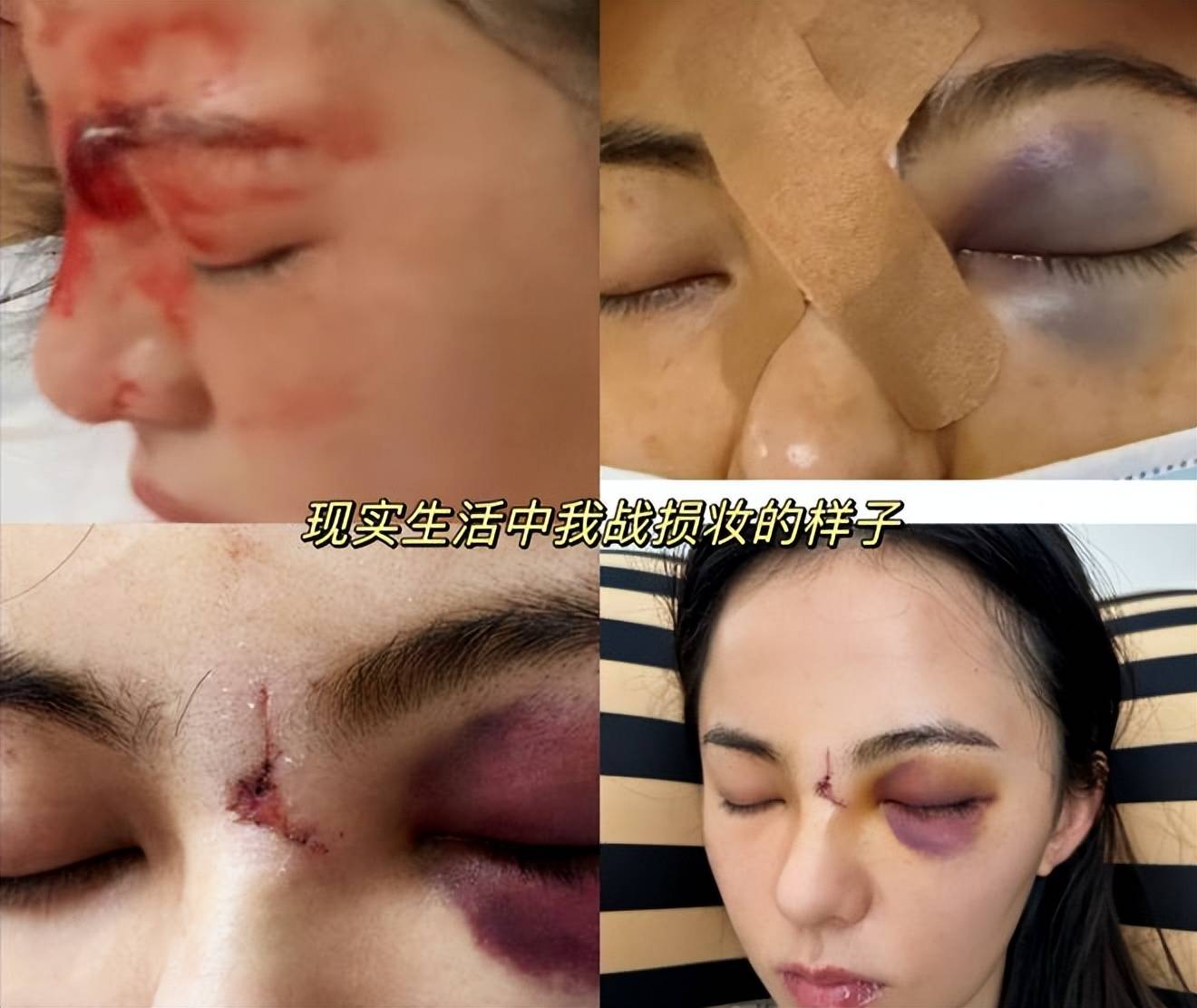 网传女演员黄日莹武训时受伤,脸部缝了7针,本人晒照回应