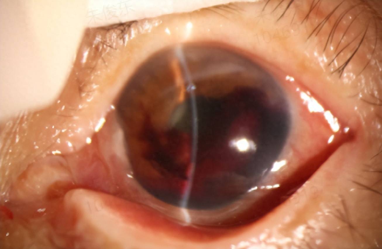塑料管弹眼致前房积血,68岁阿姨险失明!医生紧急提醒