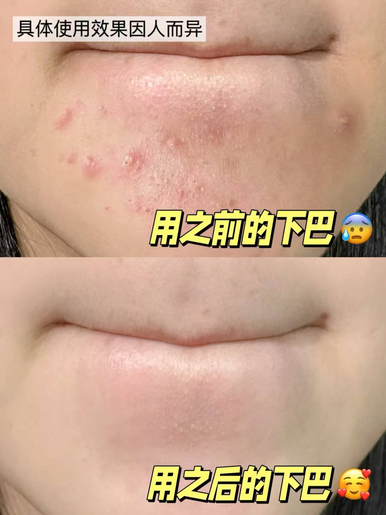 这5款祛痘精华液油痘肌闭口清透实力认证淡印修护不刺激